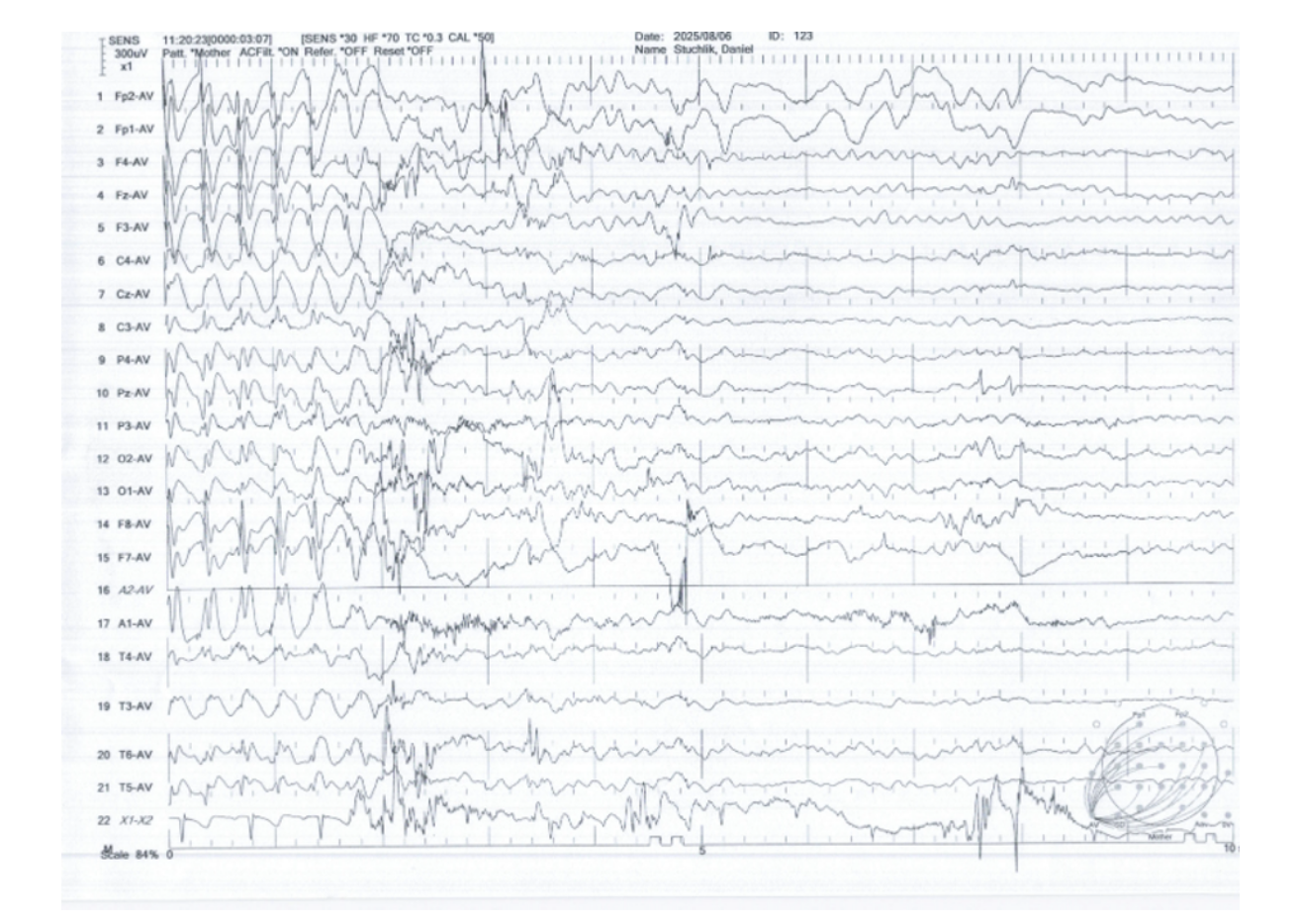 EEG recording image supplied for Daniel’s story